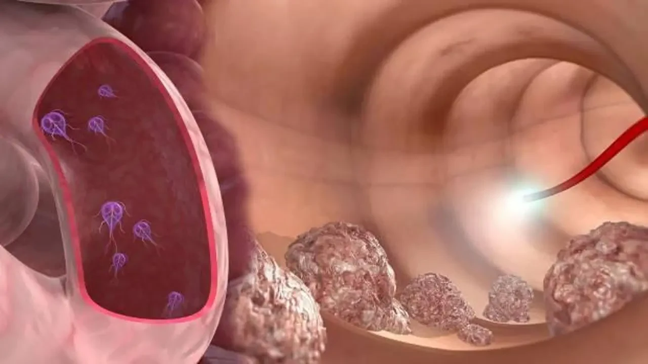 Kolon (Bağırsak) Kanseri Nedir? Belirtileri, Nedenleri ve Tedavisi