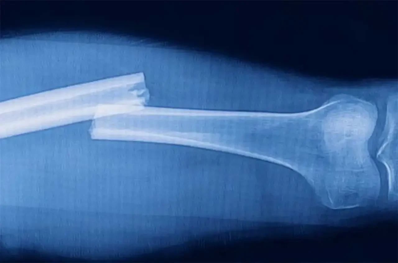 Açık Kırık Nedir?