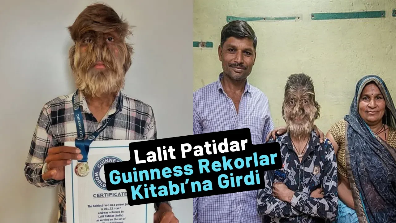 Dünyanın En Kıllı Yüzüne Sahip Genç: Lalit Patidar Guinness Rekorlar Kitabı’na Girdi