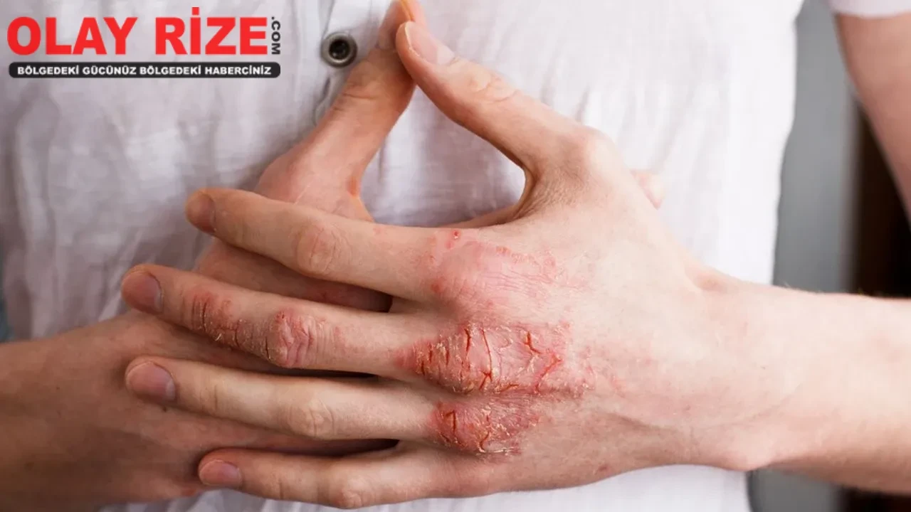 Egzama Nedir, Nasıl Geçer?