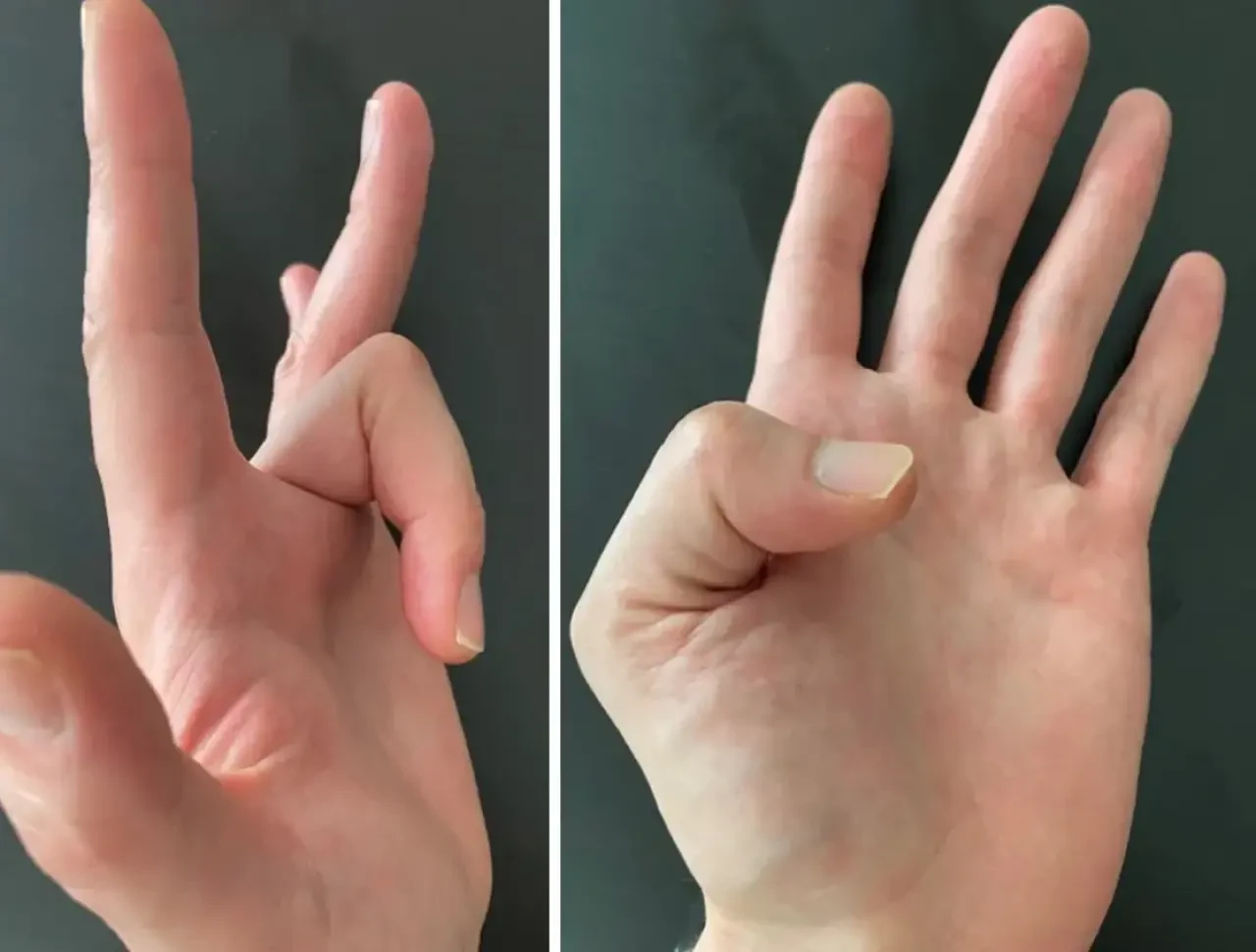 Tetik parmak nedir? Tetik parmak tedavi yöntemleri nelerdir?