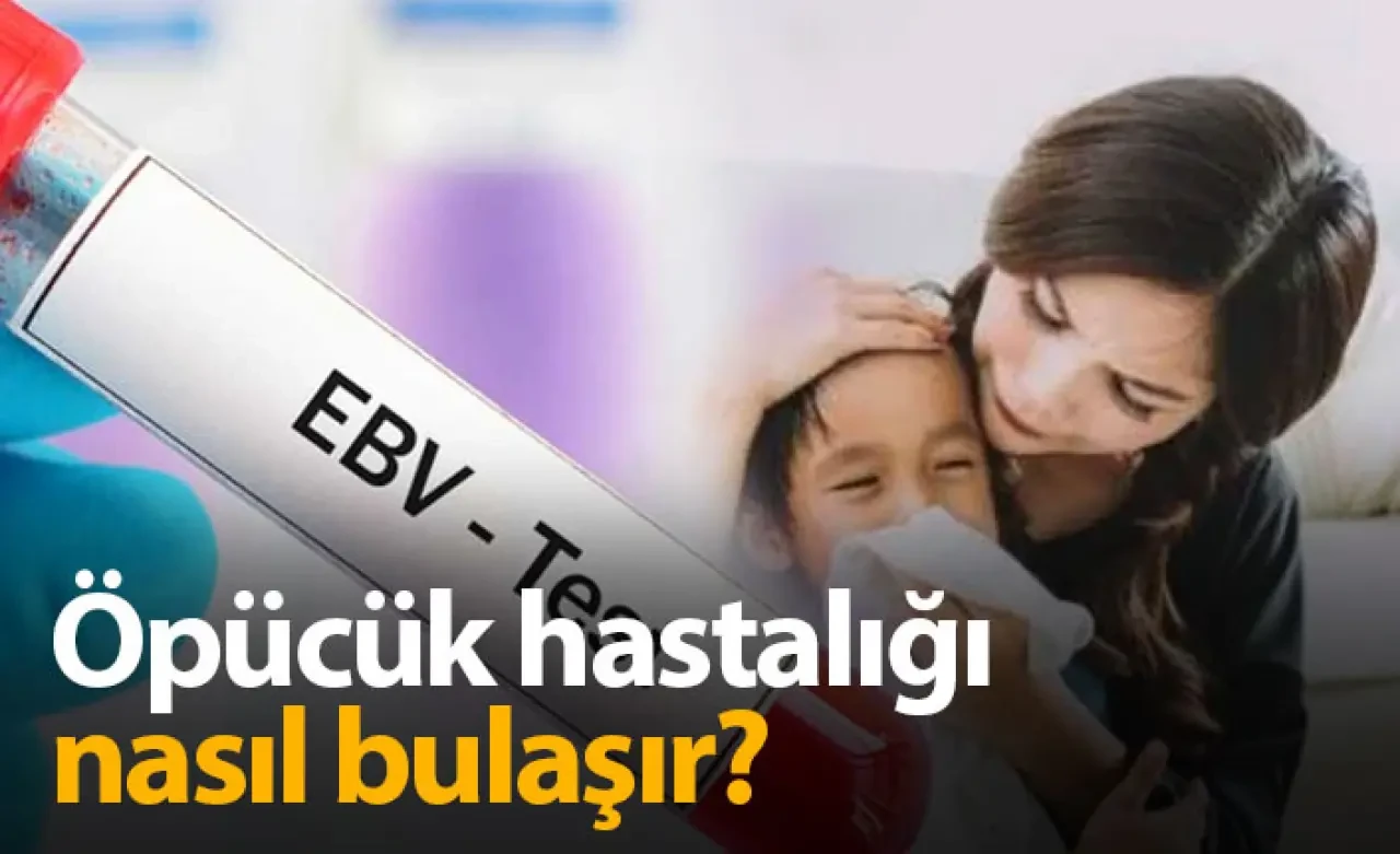 Öpücük Hastalığı Nasıl Bulaşır ? Öpücük Hastalığı nedir?