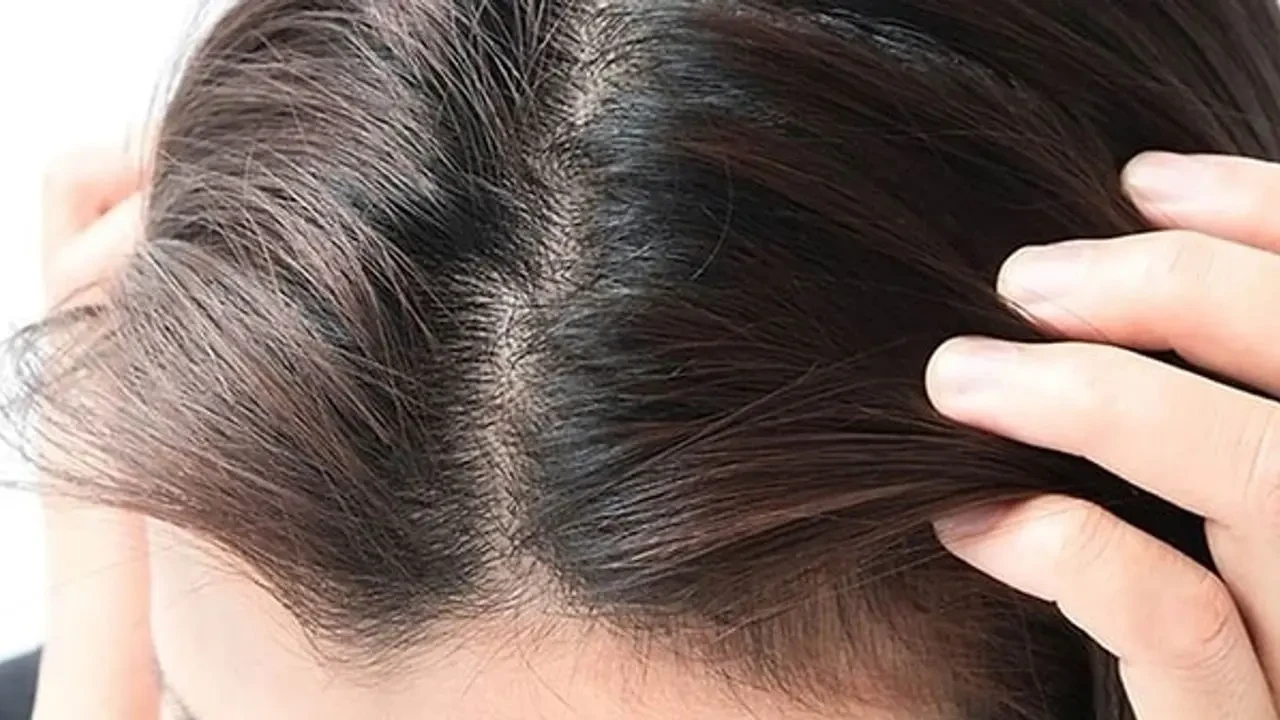 Kafa Derisinde Neden Sivilce Çıkar?