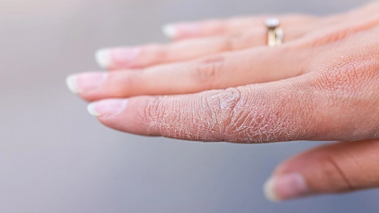 Yaz aylarında egzama hastaları için cilt bakımında dikkat edilmesi gereken 5 temel ipucu