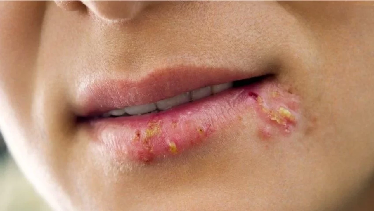 Dudak Uçuğuna Ne İyi Gelir? Dudak Uçuğu İçin Evde Ne Yapılır?