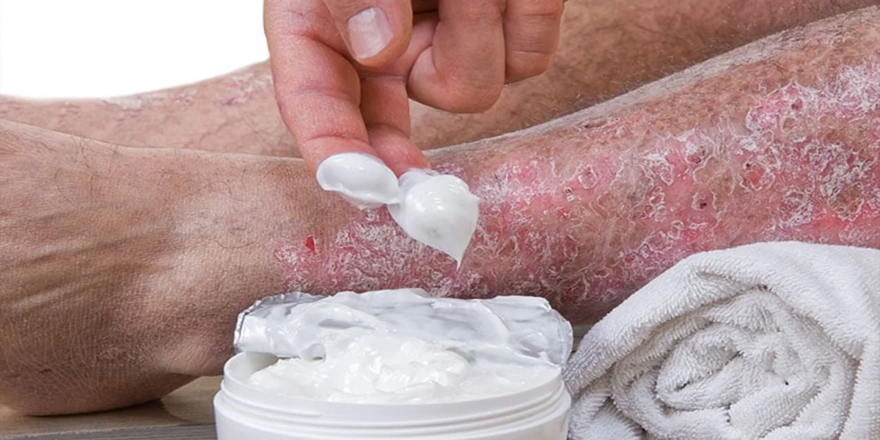 Sedef Hastalığına İyi Gelen Kremler Hangileri? En İyi ve En Etkili Sedef Hastalığı İlaçları