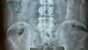 Bağırsaklarında Tam 1 Kilogramdan Fazla Eroin Bulundu!