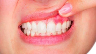 Apseye Dikkat: Belirtileri ve Riskleri Nelerdir?