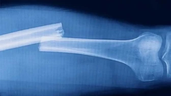 Açık Kırık Nedir?