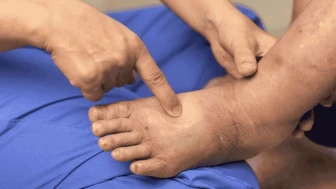 Dizde Ödem ve Şişlik Sorunlarında Erken Müdahale Büyük Önem Taşıyor!