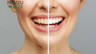 Diş Beyazlatma Uygulamaları: Kalıcılığı ve Beslenmenin Rolü Nedir?