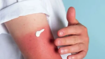 Güneş yanıklarından kurtulmak için doğal yöntemler nelerdir?