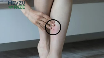Bacaklarınızdaki Pire ve Böcek Lekelerini Gidermenin Üç Etkili Yöntemi