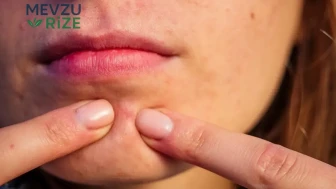 Çene Bölgesindeki Sivilceler: Hangi Organ Problemlerine İşaret Ediyor? Sivilce Tedavisinde Etkili Yöntemler