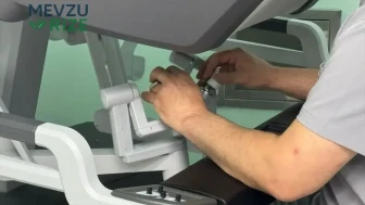 Uyku Apnesi Artık Robotik Cerrahi ile Tedavi Ediliyor!