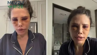 Eski Survivor Yarışmacısı Didem Ceran, Güney Kore'deki Estetik Ameliyat Sürecini Açıkladı: Deri Altındaki Kan Durduruldu