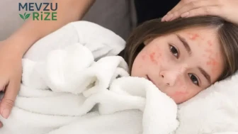 Kızamık Vaka Sayısı 35 Yılın Zirvesine Ulaştı!
