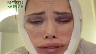 Didem Ceran'ın Estetik Yolculuğu: Güney Kore'deki Deneyimleri ve Sağlık Durumu Hakkında Son Gelişmeler