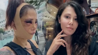Survivor Didem Ceran'ın Güney Kore'de geçirdiği estetik operasyon sonrası yeni bir ameliyat gündeme geldi!