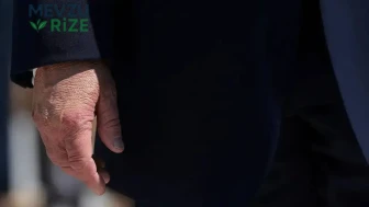Trump'ta Yeniden Beliren Gizemli Morluklar: Makyaj İle Dahi Saklanamadı!
