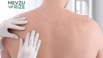 İyileşmeyen Yaralar Cilt Kanserinin Belirtisi Olabilir!