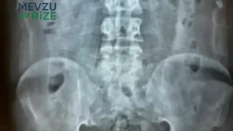 Bağırsaklarında Tam 1 Kilogramdan Fazla Eroin Bulundu!