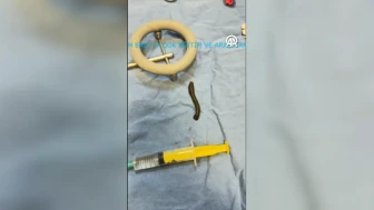 Çorum'da bir hastanın boğazından canlı sülük çıktı