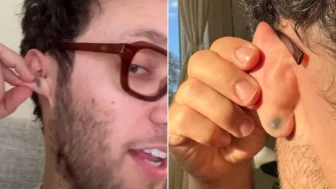 Kulağında yeşil leke vardı: Gerçek dişçide çekilen röntgenle ortaya çıktı: Meğer 20 yıldır oradaymış