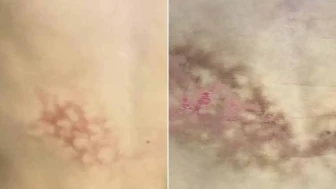 Laptopla Sıcak Sandalyede Çalışanlar Dikkat: 'Kızarmış Cilt Sendromu' Tehlikesi!
