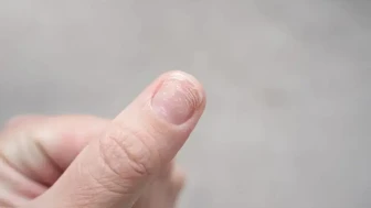 Tırnak diplerindeki renk değişimi neden olur ? Hangi hastalığın habercisi ?