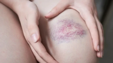 Cildinizdeki Morarmaların Nedenleri ve Zerdeçalın Koruyucu Etkisi!