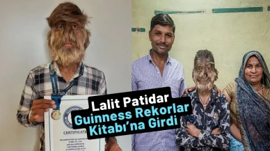 Dünyanın En Kıllı Yüzüne Sahip Genç: Lalit Patidar Guinness Rekorlar Kitabı’na Girdi
