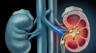 Böbrek taşı belirtileri neler? Sessiz ilerliyor mu?