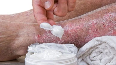 Sedef Hastalığına İyi Gelen Kremler Hangileri? En İyi ve En Etkili Sedef Hastalığı İlaçları