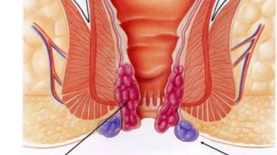 Dış Basur Nedir? Belirtileri ve Tedavi Yöntemleri