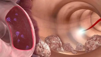 Kolon (Bağırsak) Kanseri Nedir? Belirtileri, Nedenleri ve Tedavisi