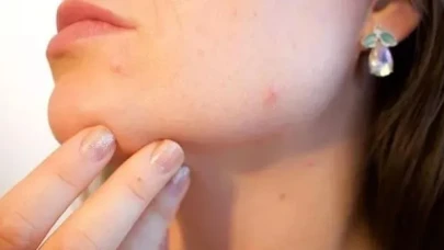 Rüyada Sivilce Sıkmak Ne Anlama Geliyor?