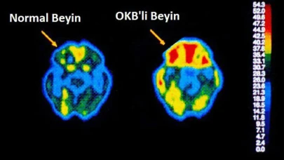 Obsesif kompülsif bozukluk nedir?