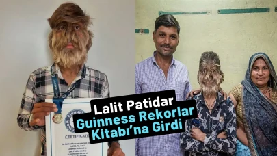Dünyanın En Kıllı Yüzüne Sahip Genç: Lalit Patidar Guinness Rekorlar Kitabı’na Girdi