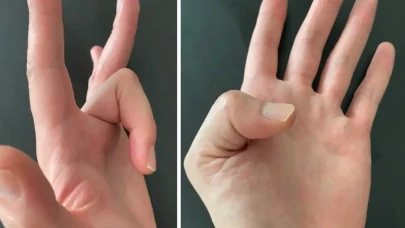 Tetik parmak nedir? Tetik parmak tedavi yöntemleri nelerdir?