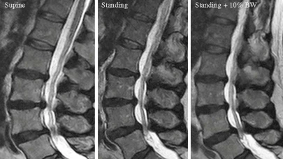 Lomber Vertebra Kontrastsız Nedir