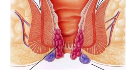 Dış Basur Nedir? Belirtileri ve Tedavi Yöntemleri