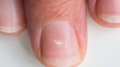 Tırnaklardaki Beyaz Lekelerin Anlamı Nedir?