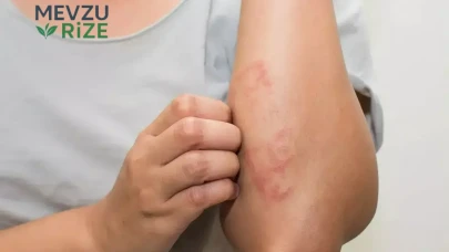 Vucutta neden  kabarık yara çıkar ?