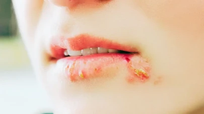 Dudakta Uçuk Neden Çıkar? Uçuk Nasıl Geçer, Bulaşıcı mı? İşte En Hızlı Uçuk Tedavisi ve Tekrarlayan Uçukların Nedenleri