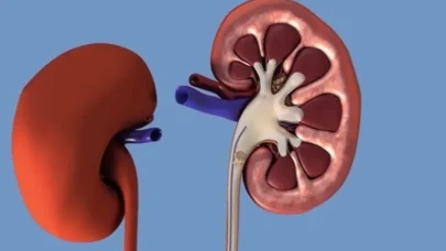Böbrek Stentinin Ardından Görülen Kritik Belirtiler: Takipte Olun!