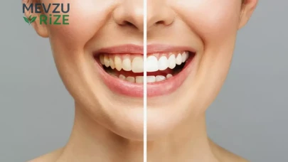 Diş Beyazlatma Uygulamaları: Kalıcılığı ve Beslenmenin Rolü Nedir?