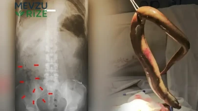 Bangladeş'te Şok Edici Olay: Balık Avlarken Rektumundan Yılan Balığı Çıkarılan Adam Ameliyatla Kurtarıldı!