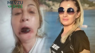 Antalya'da Estetik Skandalı: Göz Altı Dolgusu Yüzünden Dudak Dokusunu Yitiren Kadın Şokta!