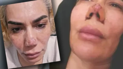 Burnunun yarısı yırtıldı: Estetik yaptırdığına bin pişman oldu